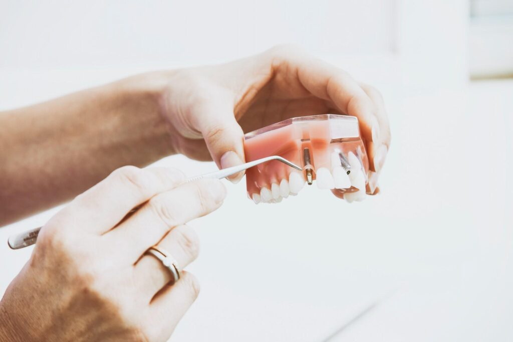 Free Dental Implants Clinical Trials