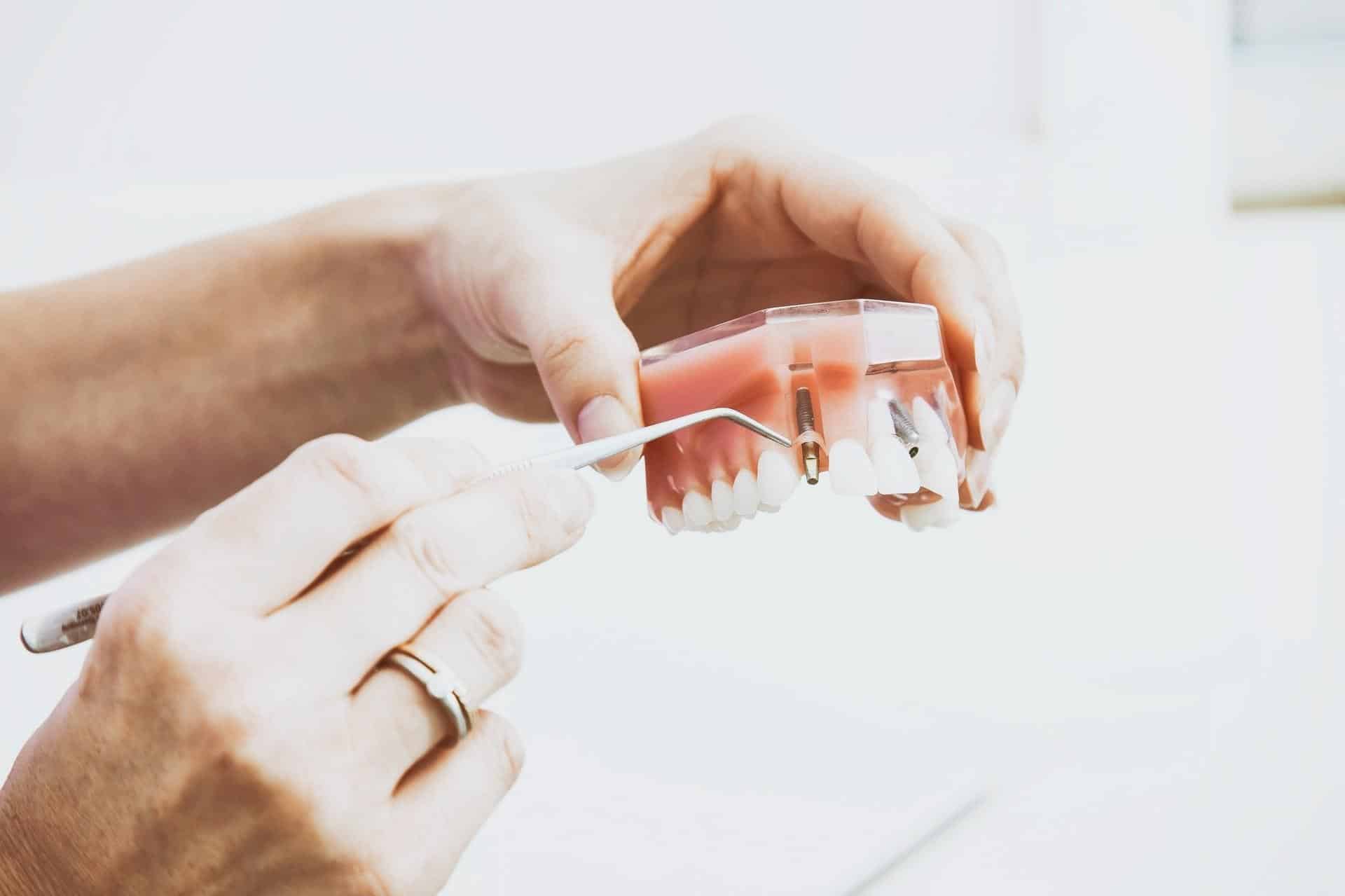 Free Dental Implants Clinical Trials 2022 - How to Apply?