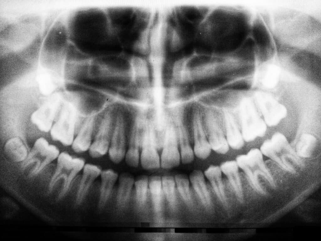 Free dental Implants for Recovering Addicts - Bad Effects