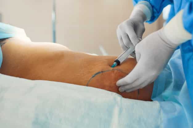 Grants for Plastic Surgery after Weight Loss