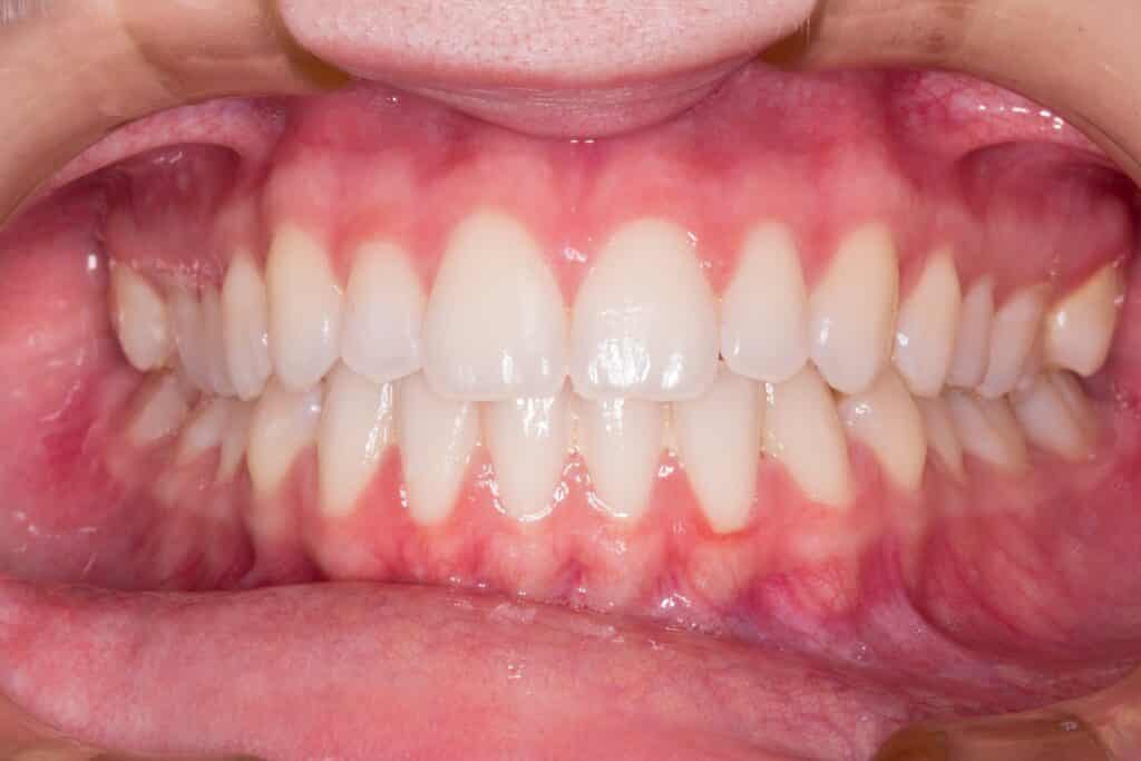Dental Grants in North Carolina - Spreading Healthy Smiles