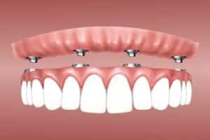 In House Financing for Dental Implants Benefits of Dental Implants