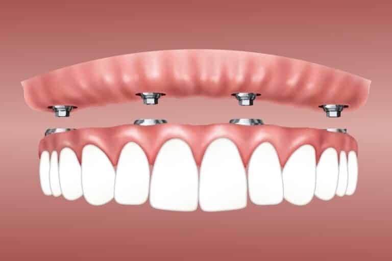 Benefits of Dental Implants
