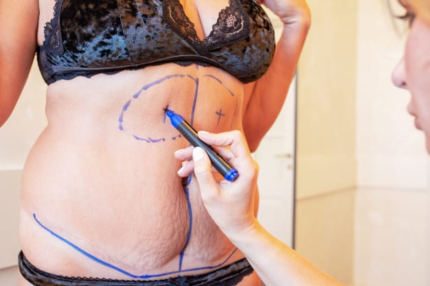 What is a Mommy Makeover Cost? - Learn More!