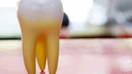 Stem Cell Dental Implants Clinical Trials