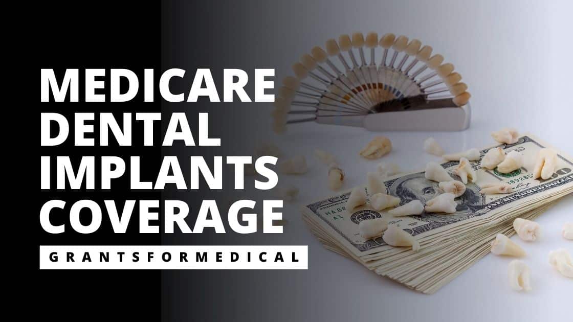 Does Medicare Cover Dental Implants? Grants for Medical