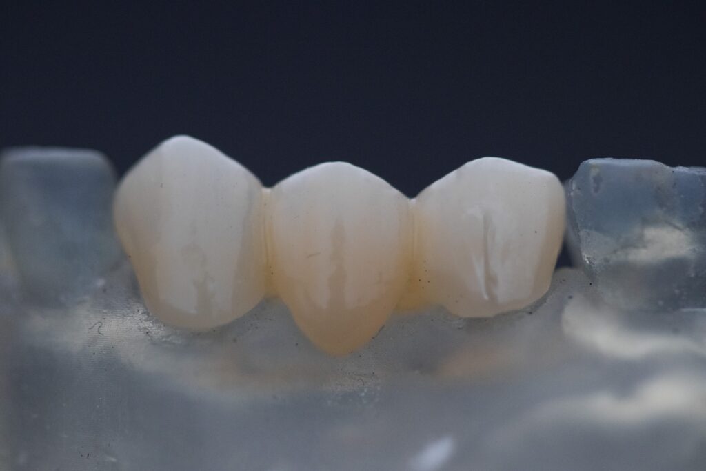 Types of Dental Implants Cost - Treatment Methods