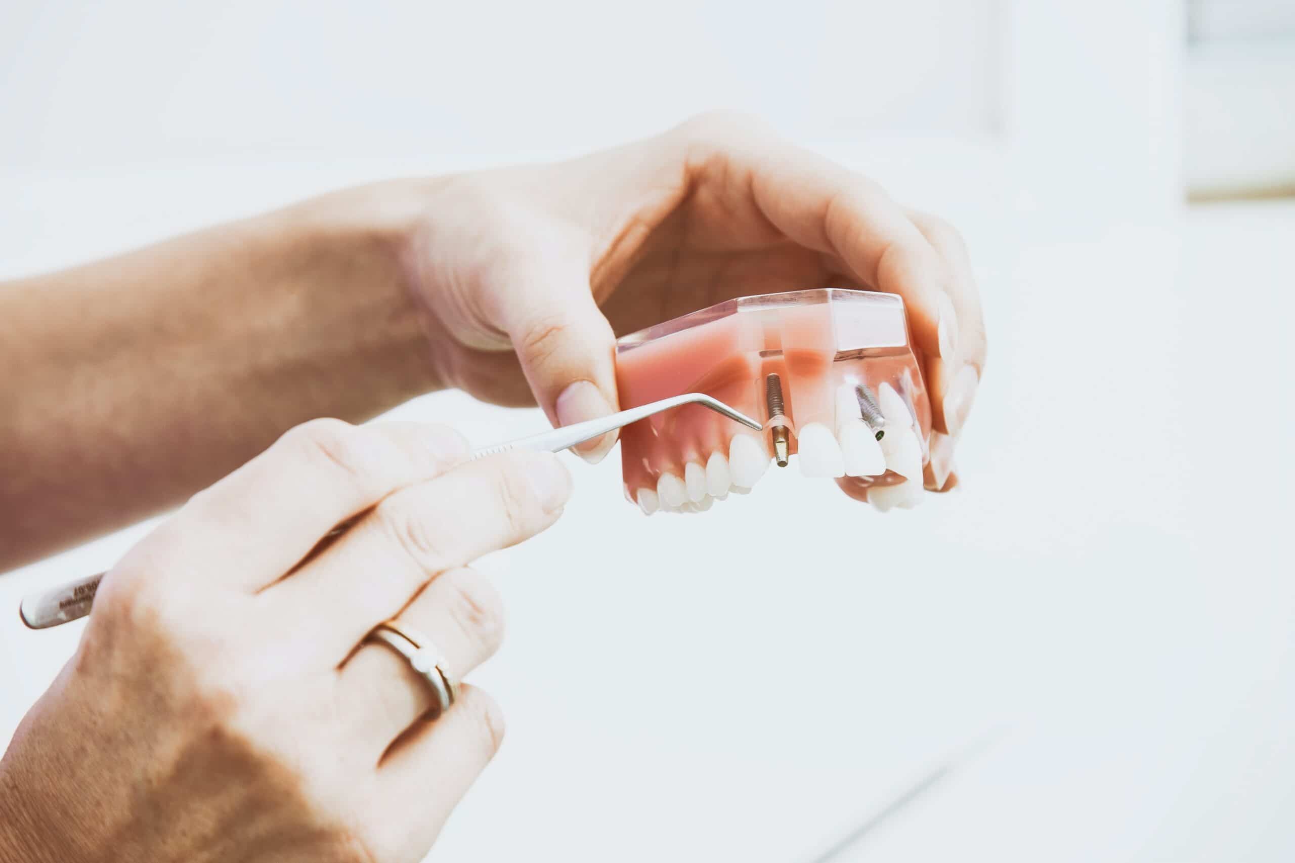 Types of Dental Implants Cost