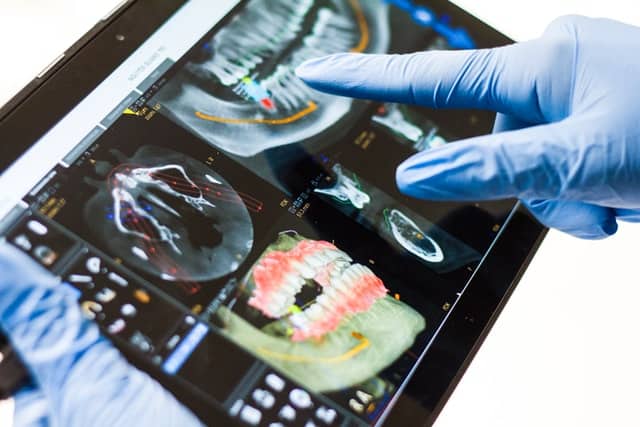 How to Get Dental Implants Covered by Insurance