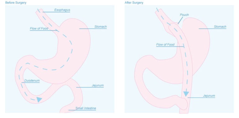 What is Gastric Bypass