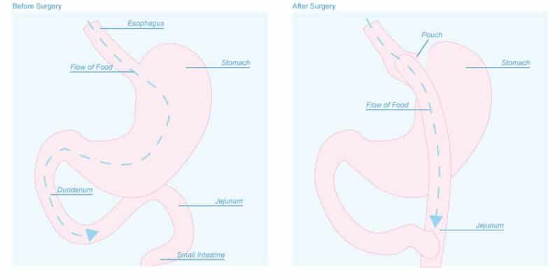 What is Gastric Bypass