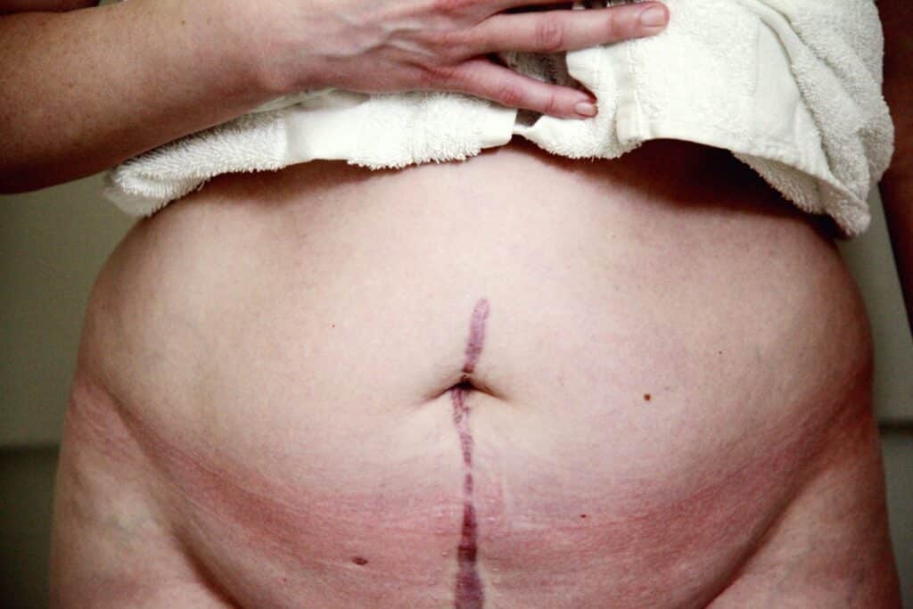 What is apronectomy - solutions