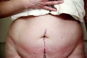 What is apronectomy What is apronectomy - solutions