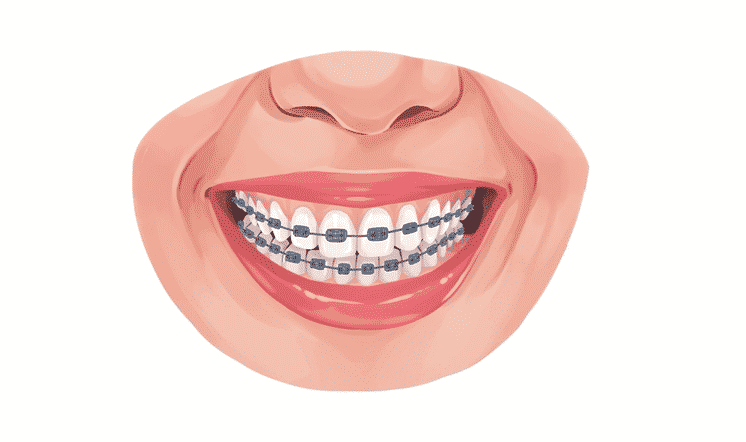 Does Medicaid Cover Braces How To Qualify does-medicaid-cover-braces-how-to-qualify