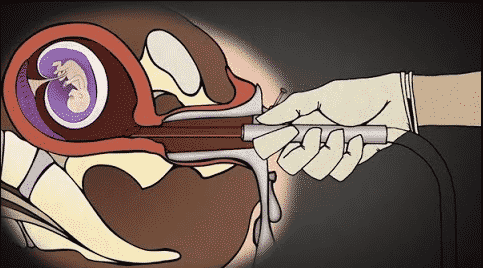 Does Medicaid Cover Abortions