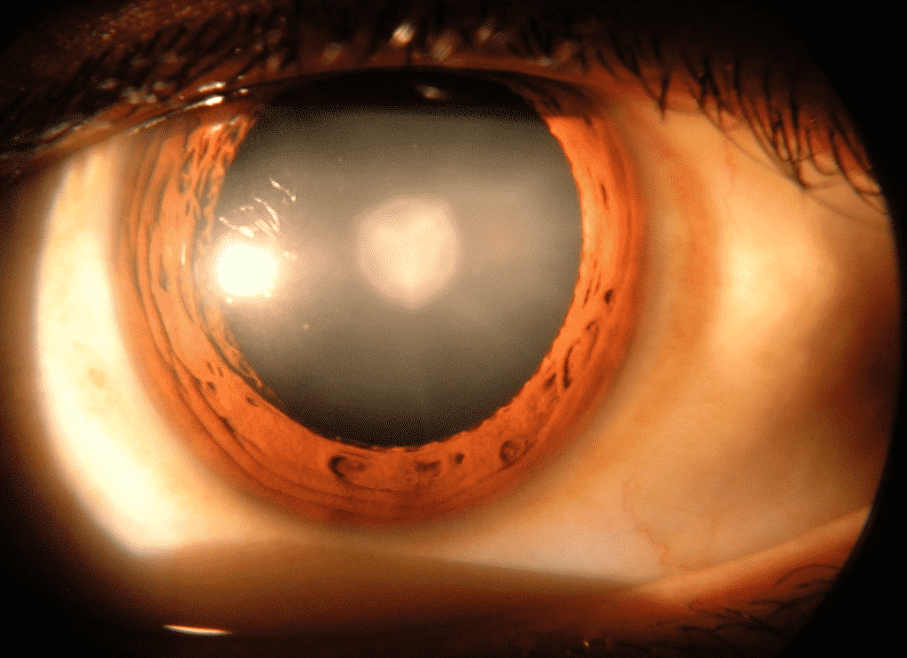 Does Medicare Cover Eye Exams - Cataract Surgery