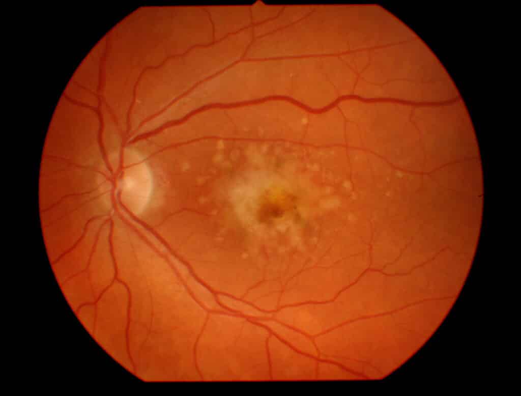 Does Medicare Cover Eye Exams - Macular Degeneration