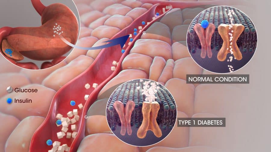 Type 1 Diabetes Mellitus Clinical Trials - What is Type 1DM