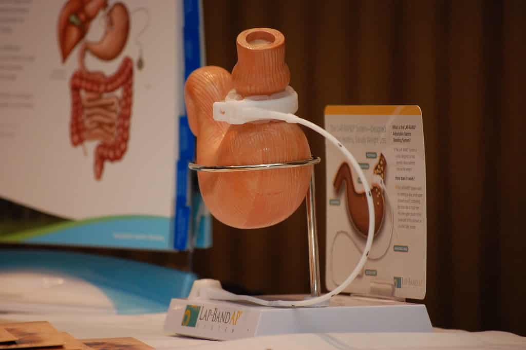 Types of Weight Loss Surgery - What is a weight loss surgery