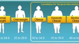 types of weight loss surgery