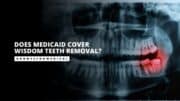 Does Medicaid Cover Wisdom Teeth Removal