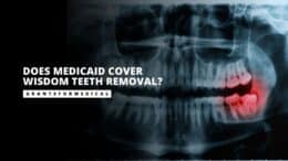 Does Medicaid Cover Wisdom Teeth Removal