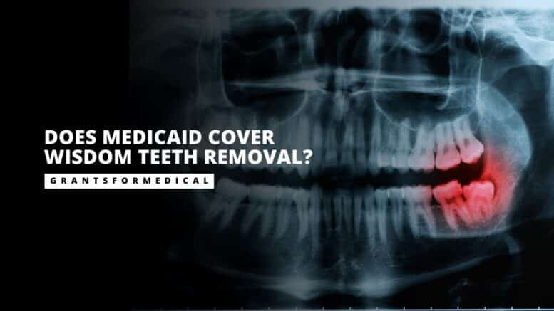 Does Medicaid Cover Wisdom Teeth Removal