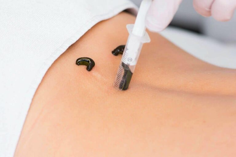 Leech Therapy