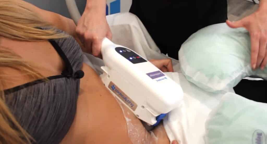 What is CoolSculpting