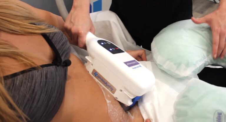 What is CoolSculpting