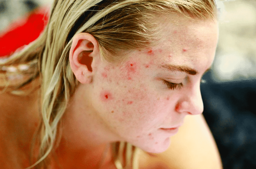 How to Become a Dermatologist - Acne
