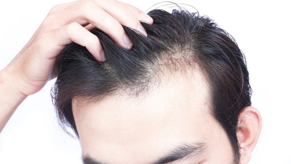 hair loss