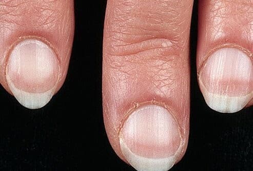How to Become a Dermatologist - nail problems