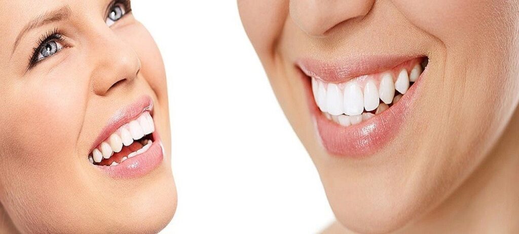 veneers
