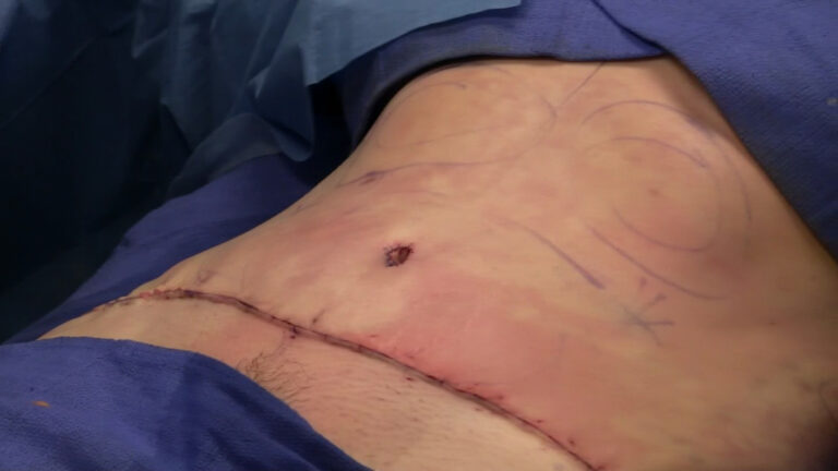 Abdominoplasty completely sutured