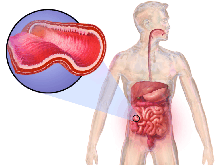 Crohns Disease