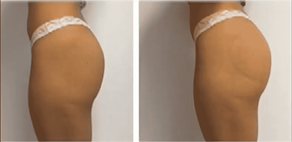 Brazilian Butt Lift