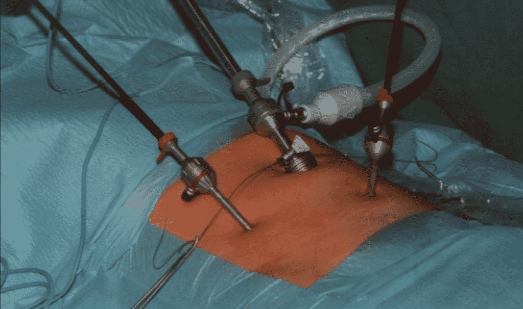 Average Cost of Hernia Surgery without Insurance