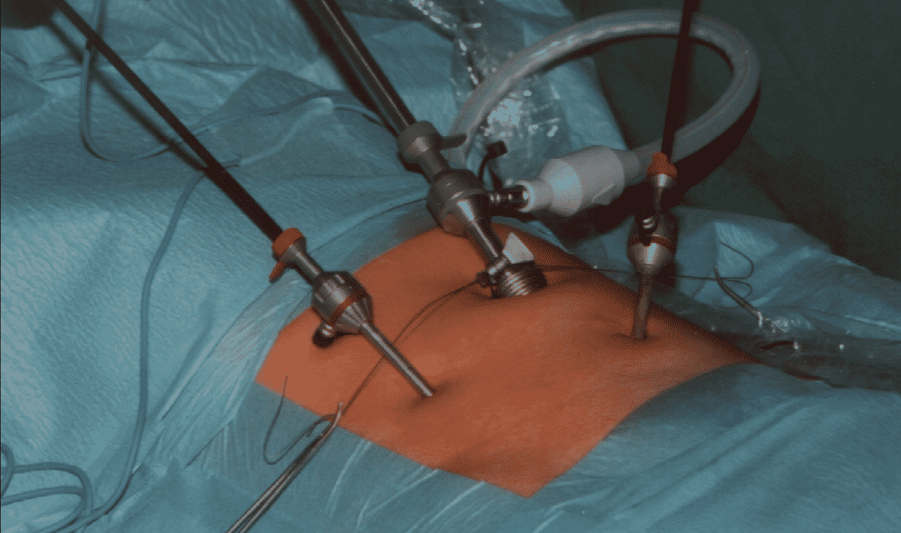 Average Cost of Hernia Surgery without Insurance