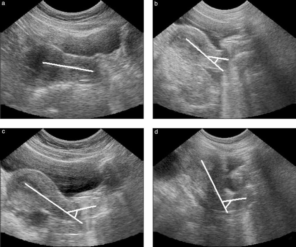 Stages of IVF