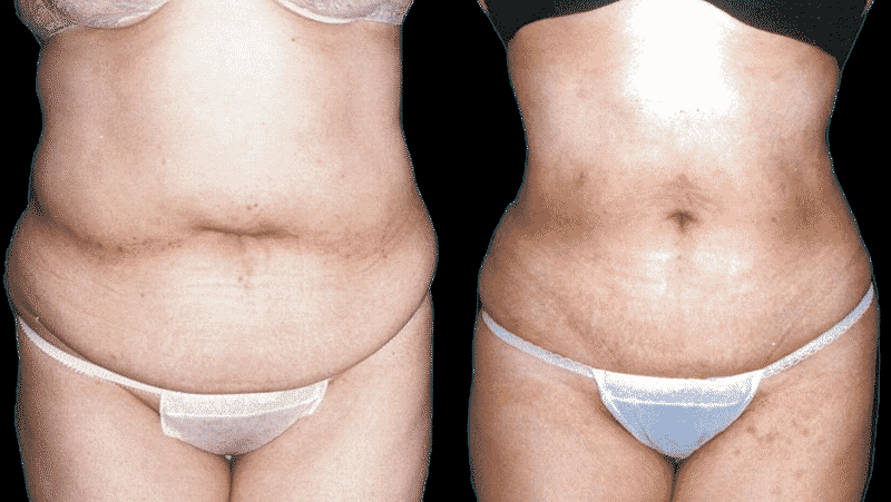 Types of Plastic Surgery