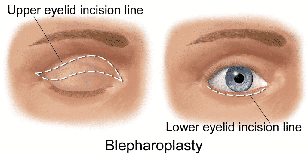 Types of Plastic Surgery