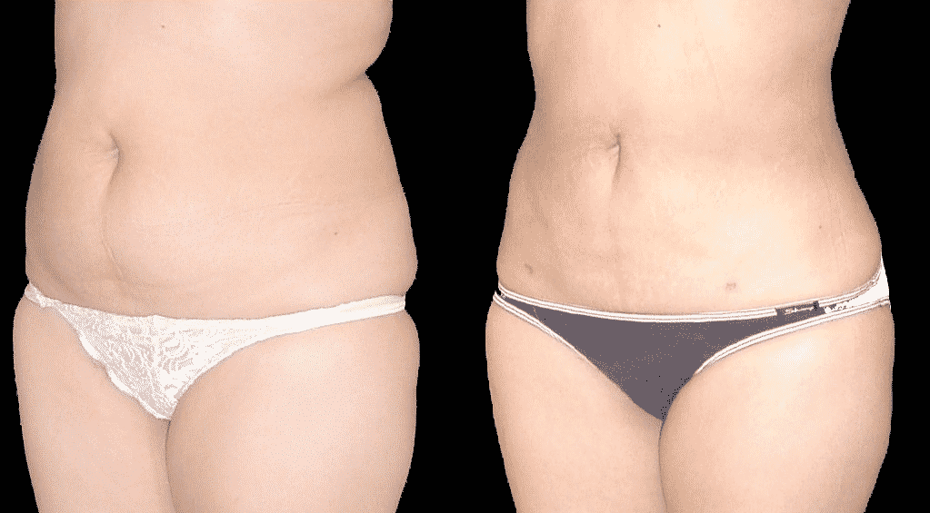 Types of Plastic Surgery