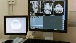 Does Medicare Cover Bone Density Tests