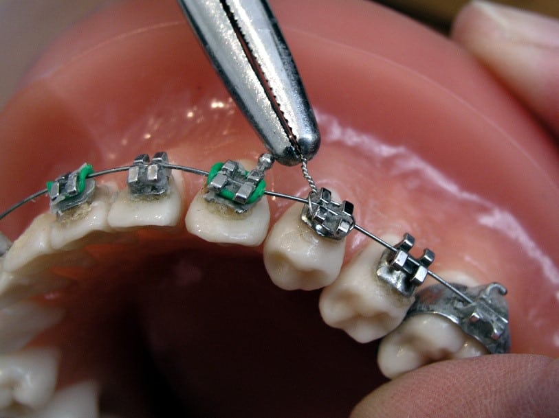 How long does Braces Pain Last?