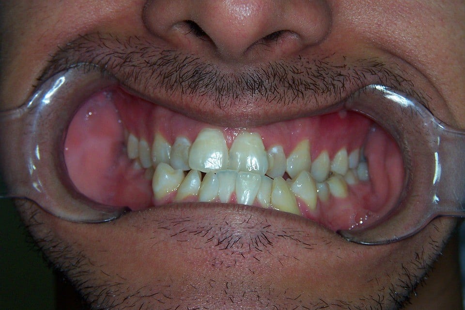 How Long Do Braces Last? Grants for Medical