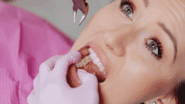 Does Medicare cover Braces