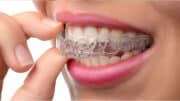 What are the Different Types of Braces