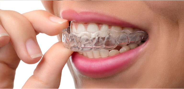 What are the Different Types of Braces