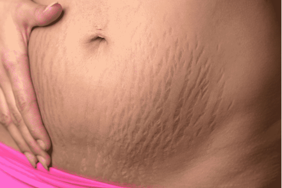 Mommy Makeover Cost in Houston